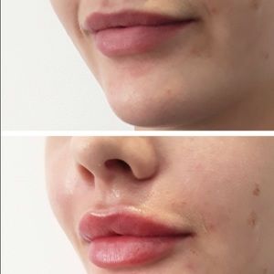 Lip injections